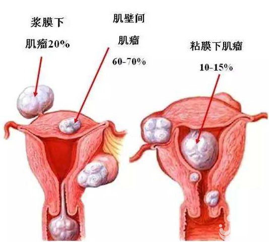 子宮肌瘤疾病會阻礙女性懷孕嗎？