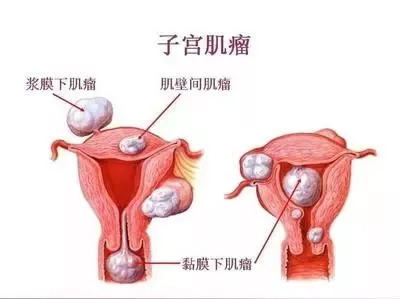 你知道為什么你會(huì)患有子宮肌瘤嗎？