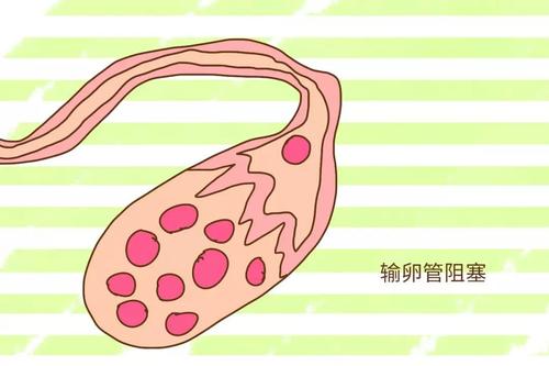 你可能還不夠了解輸卵管為什么會(huì)堵塞！