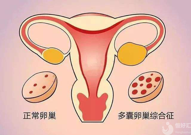 多囊卵巢綜合征，女性最痛恨的疾病之一