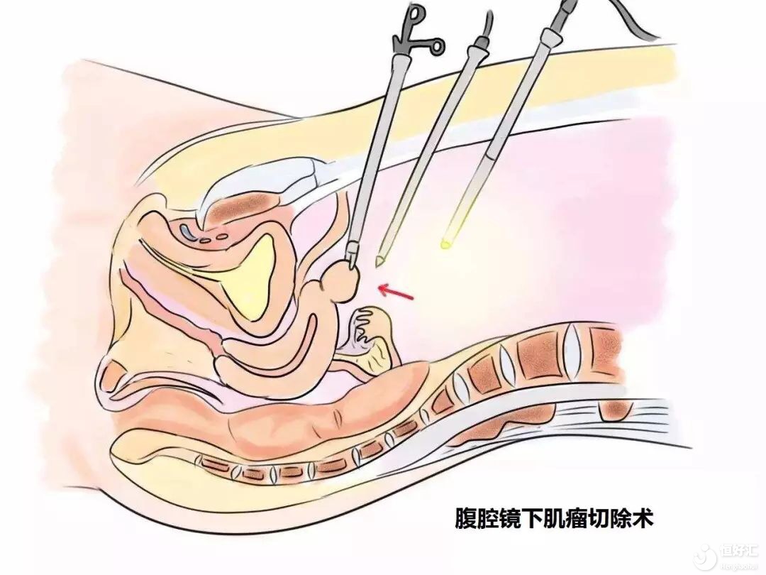 腹腔鏡從腹部穿刺檢測(cè)，會(huì)不會(huì)留疤？
