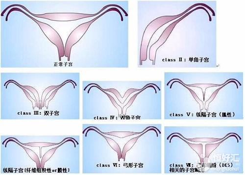 子宮畸形疾病，你了解多少？