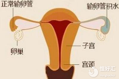 子宮異常不會影響試管嬰兒？請看完這個再下定論