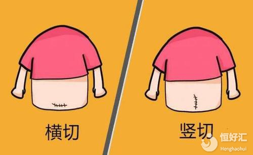 剖腹產(chǎn)橫切PK豎切：到底選擇哪個(gè)更好？