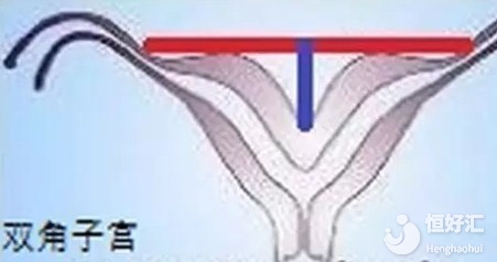 雙角子宮很可能會影響懷孕，看完才知道內幕……