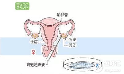 取卵數(shù)量決定試管成功率？這5點才是關(guān)鍵！