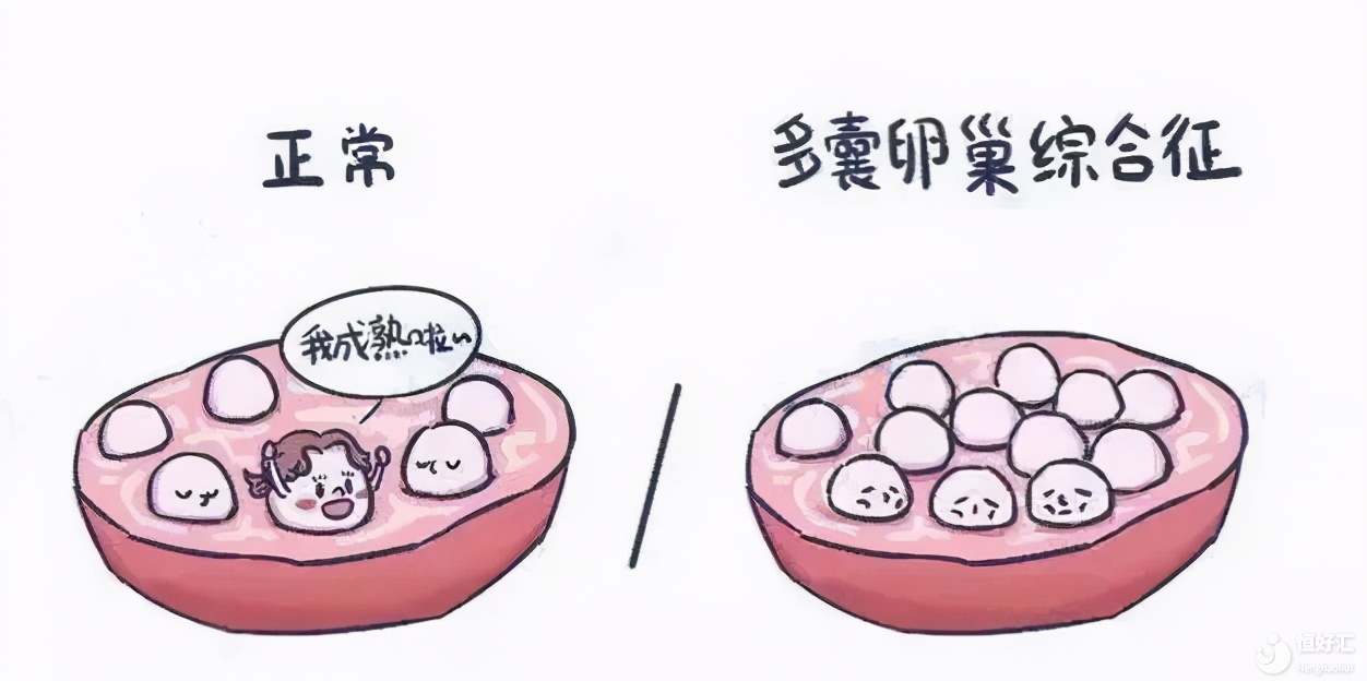 多囊卵巢拖久了會怎樣？不生育就不用治?