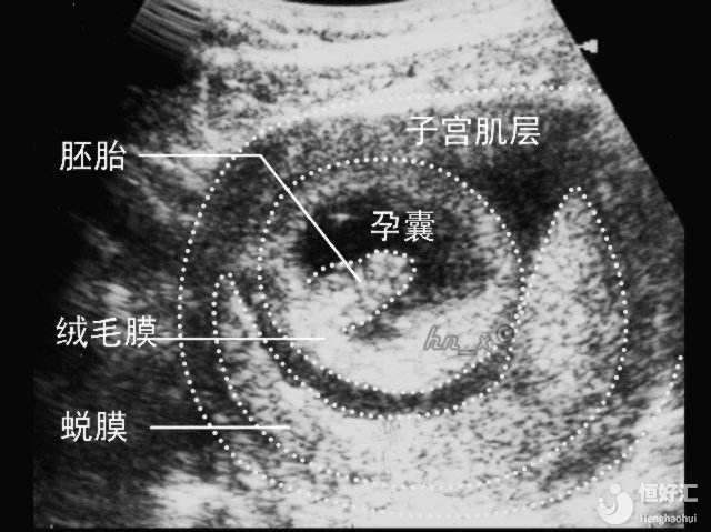生化妊娠是什么，生化妊娠會排出孕囊嗎？生化后多久可以懷孕？